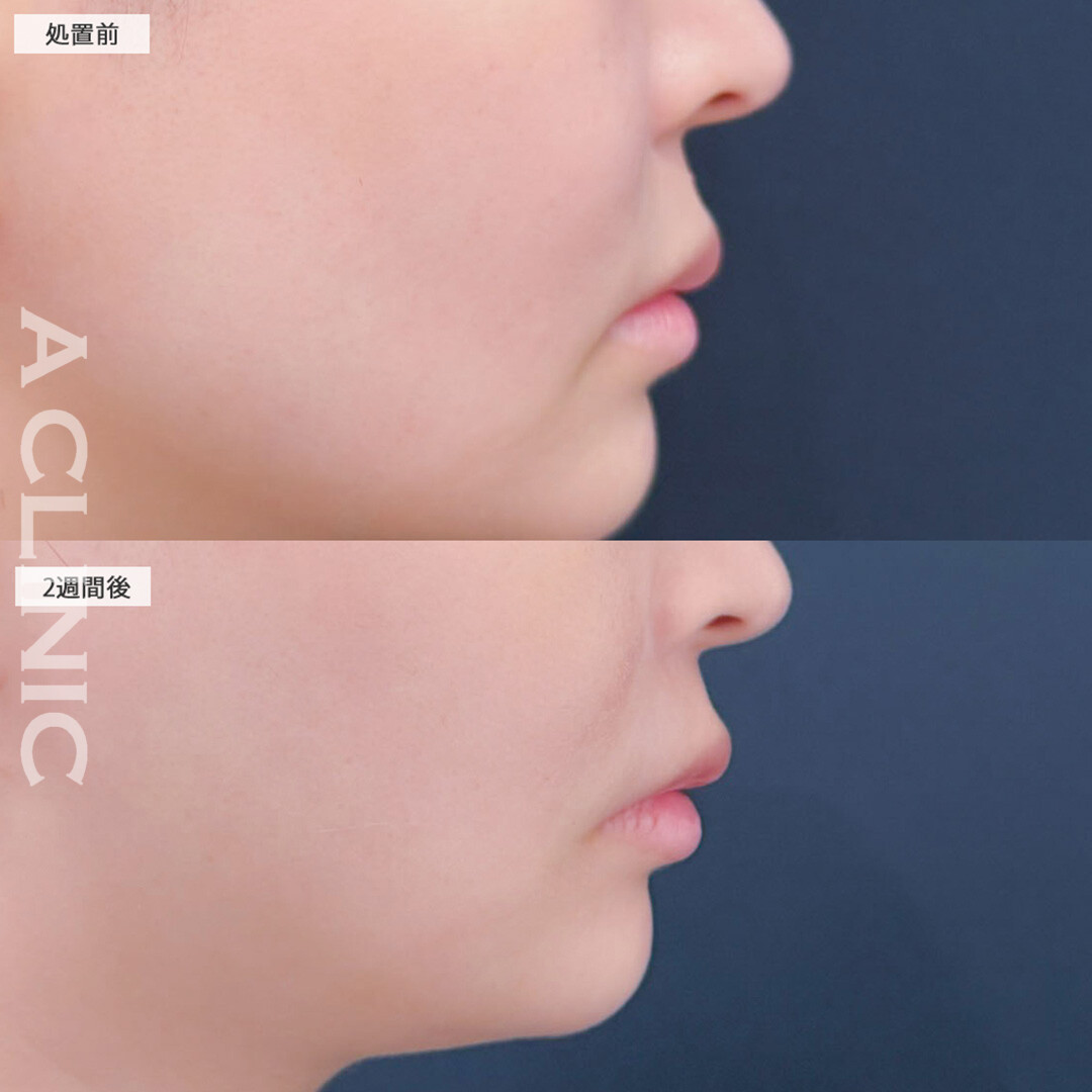 切らない人中短縮(Cカール形成術)で人中が短くなり一気に赤抜け！こちら処置前と2週間後の症例です(30代女性)