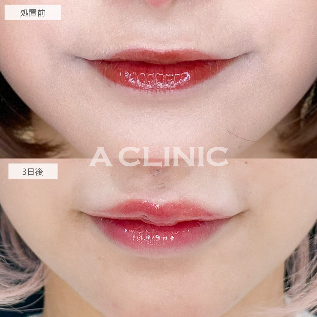 切開ナシなので不自然な傷跡を残さず人中を短縮できます！切らない人中短縮の処置前と3日後の症例です(30代女性)