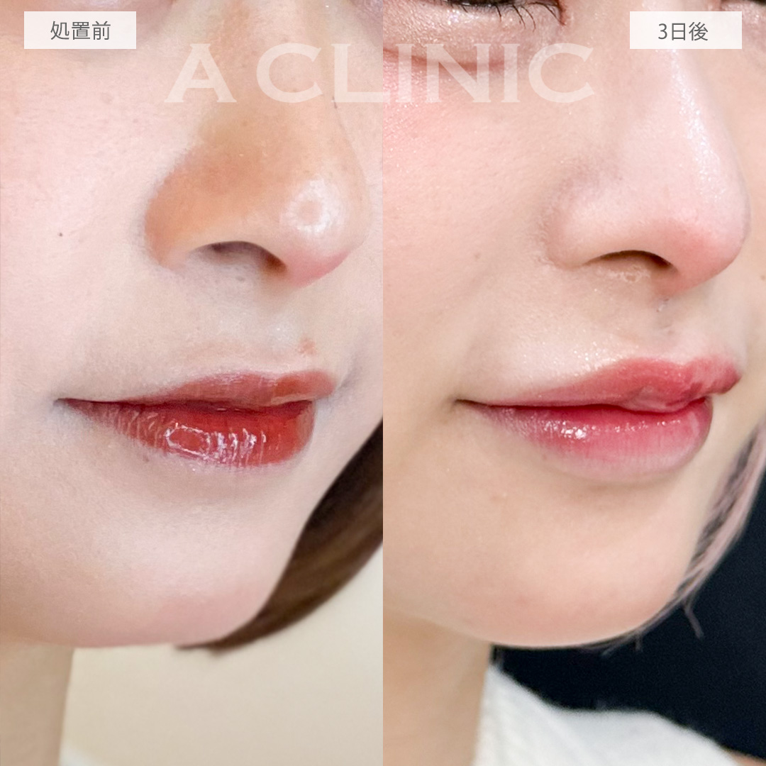 切開ナシなので不自然な傷跡を残さず人中を短縮できます！切らない人中短縮の処置前と3日後の症例です(30代女性)