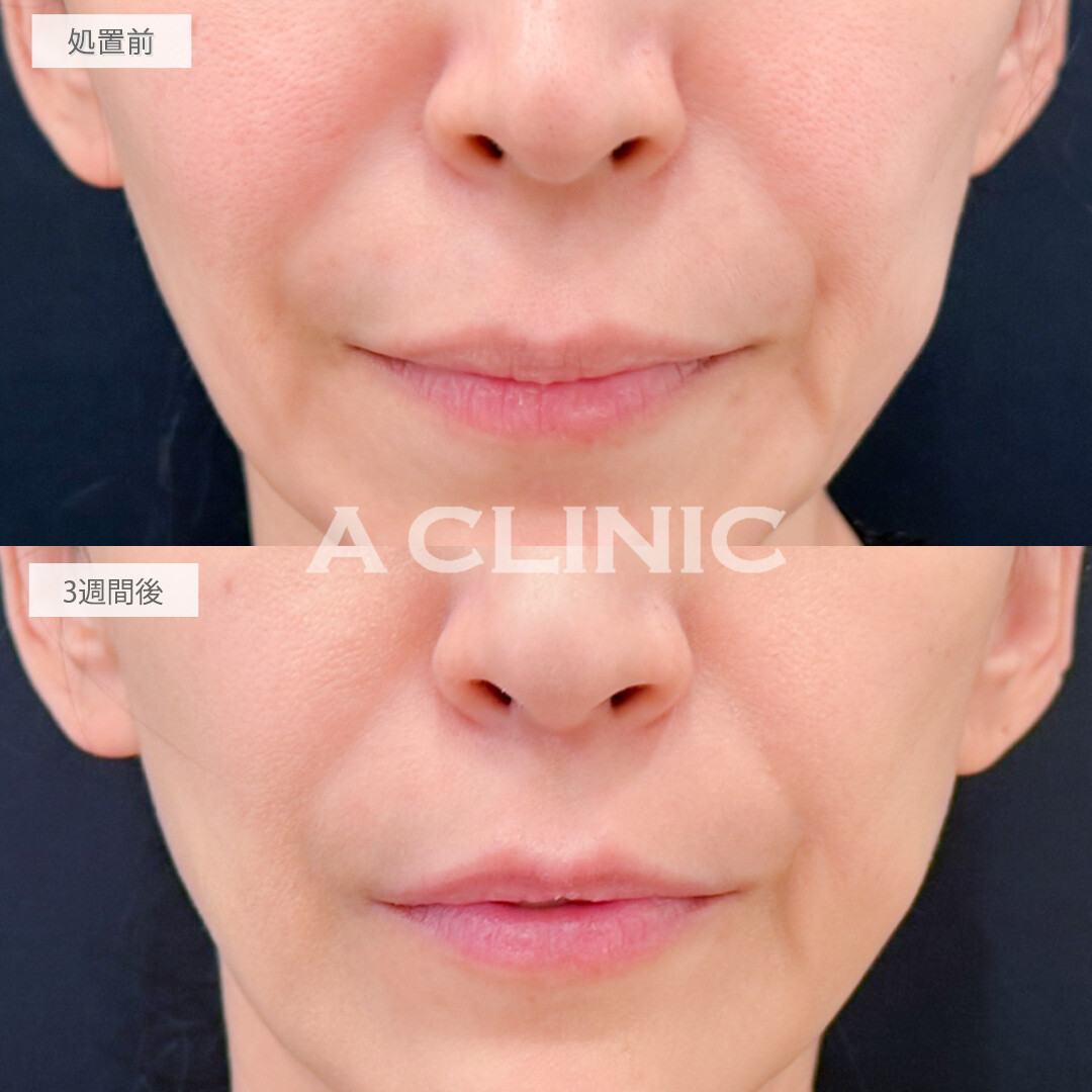 切らない人中短縮(Cカール形成術)とリップヒアルロン酸注入で年々長く伸びてくる人中を短くして老け顔改善！処置前と3週間後の症例です(40代女性)