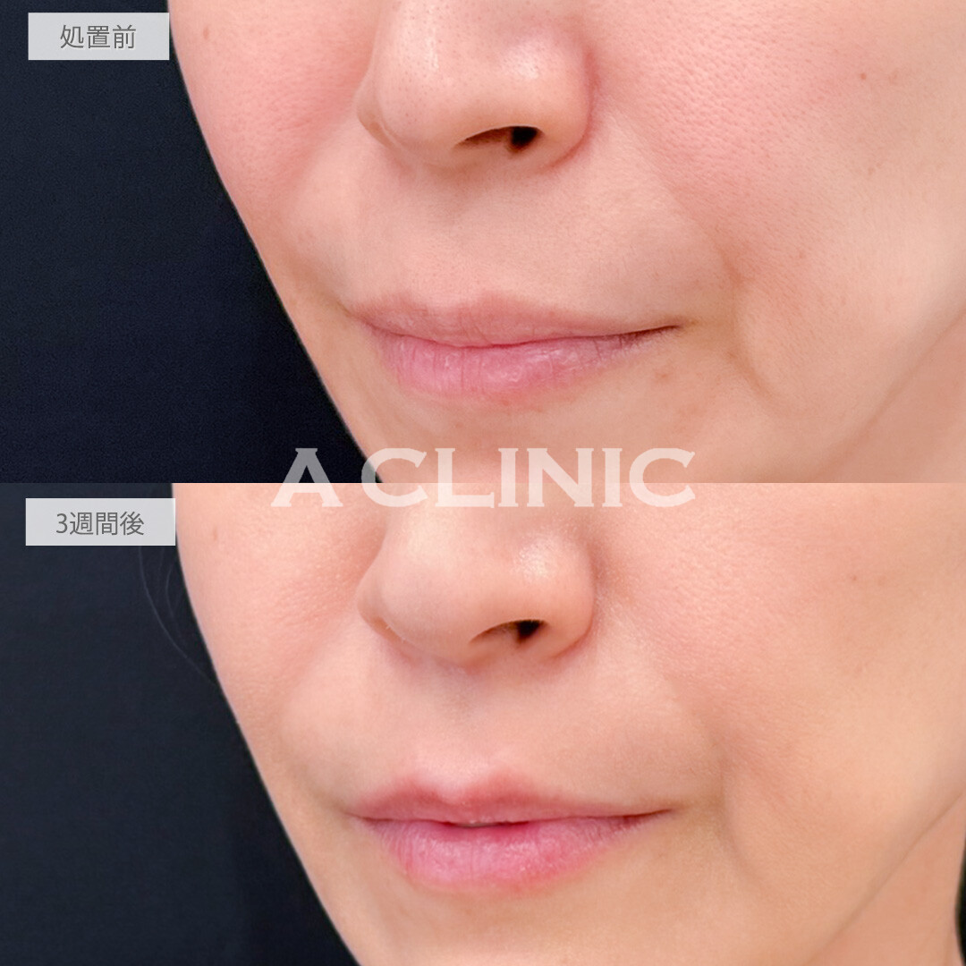 切らない人中短縮(Cカール形成術)とリップヒアルロン酸注入で年々長く伸びてくる人中を短くして老け顔改善！処置前と3週間後の症例です(40代女性)