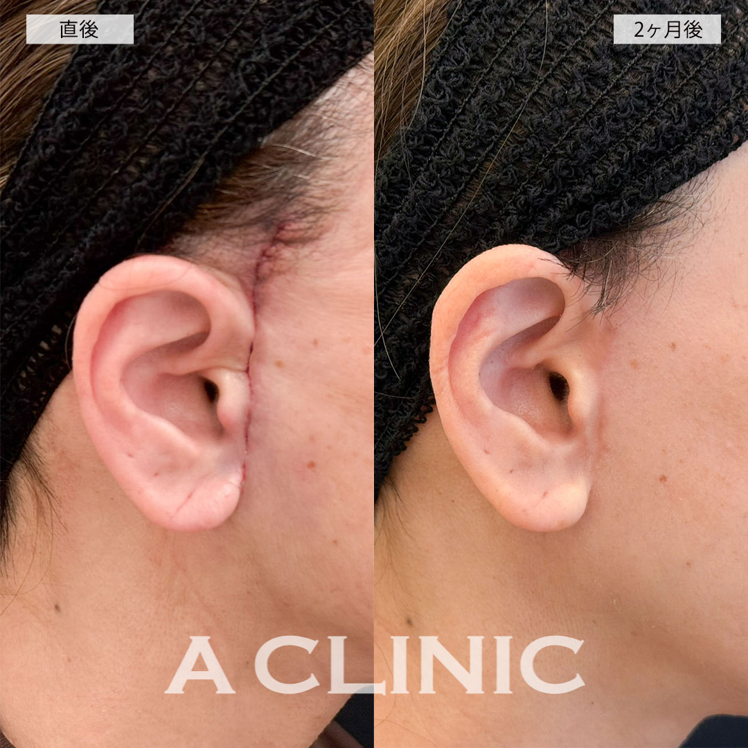 A式美肌たるみ切開で口元のシワが薄くなり若返った印象に！こちら処置前と2ヶ月後の症例です(50代女性)