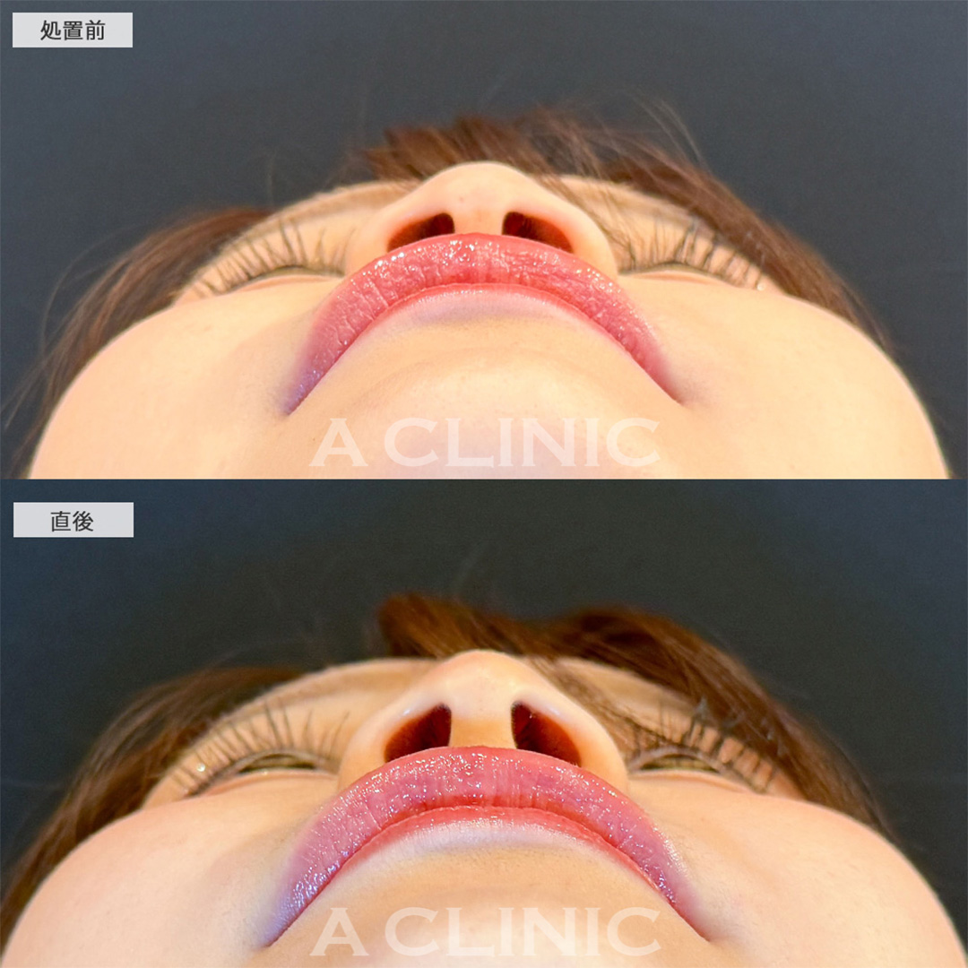 コリアンノーズで丸い鼻がツンとした鼻に！こちら処置前と直後の症例です(30代女性)