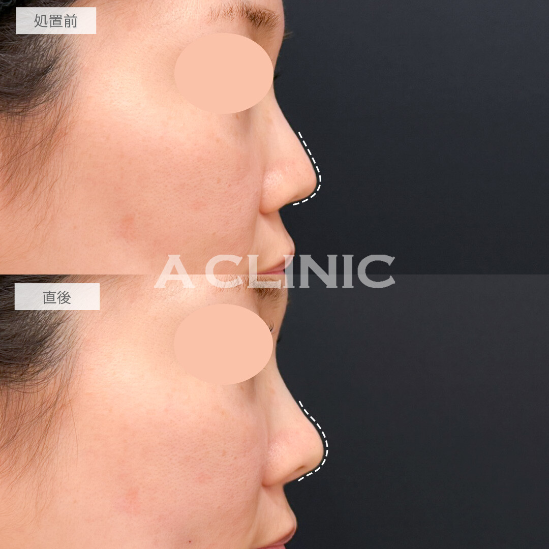 コリアンノーズで鼻先の形を変えるだけで一気にお顔のクオリティが上がります！処置前と直後の症例です(30代女性)