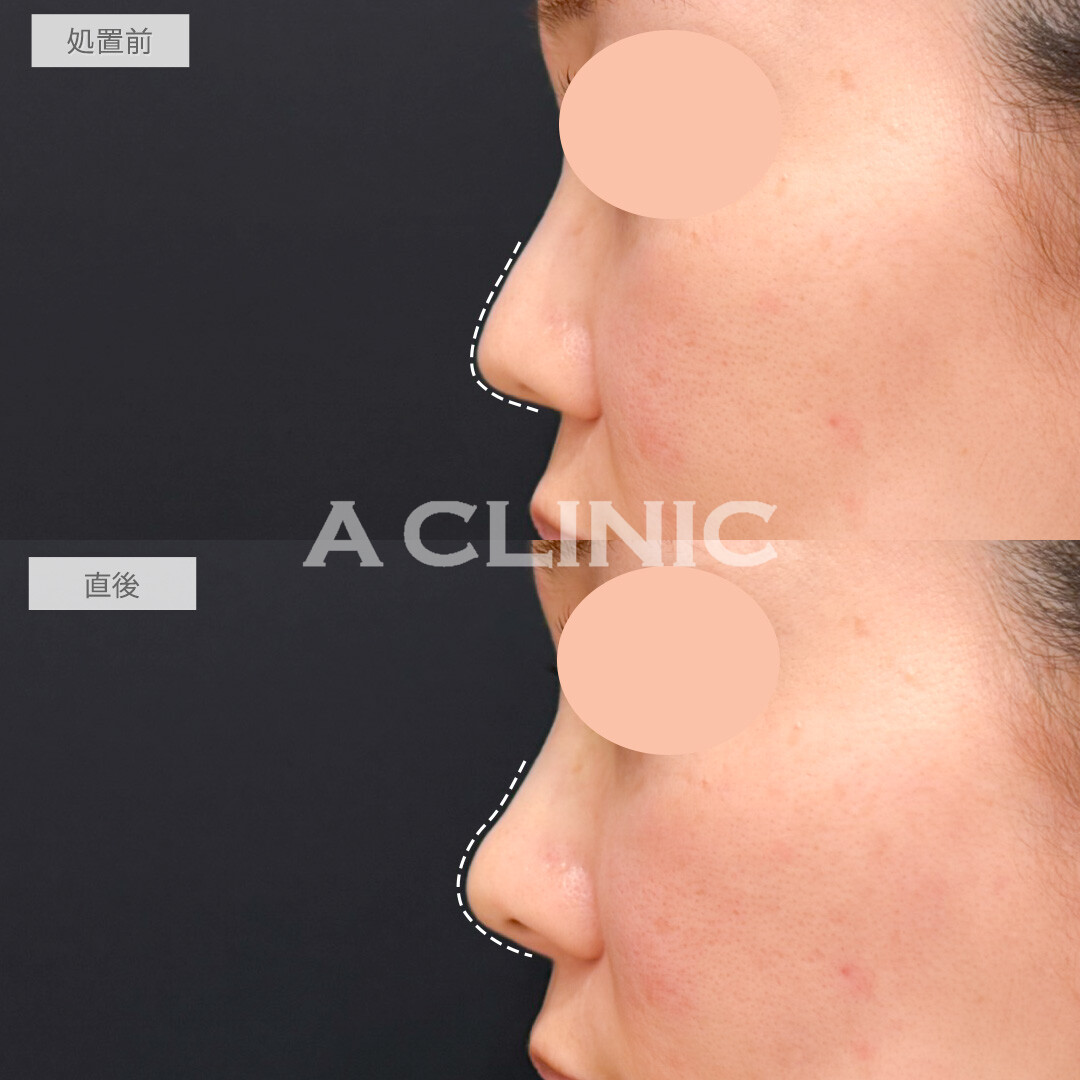 コリアンノーズで鼻先の形を変えるだけで一気にお顔のクオリティが上がります！処置前と直後の症例です(30代女性)