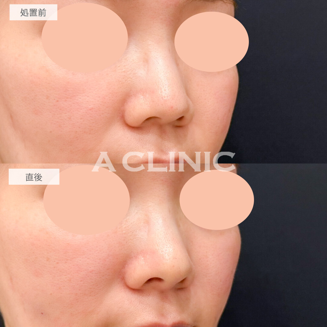コリアンノーズで鼻先の形を変えるだけで一気にお顔のクオリティが上がります！処置前と直後の症例です(30代女性)