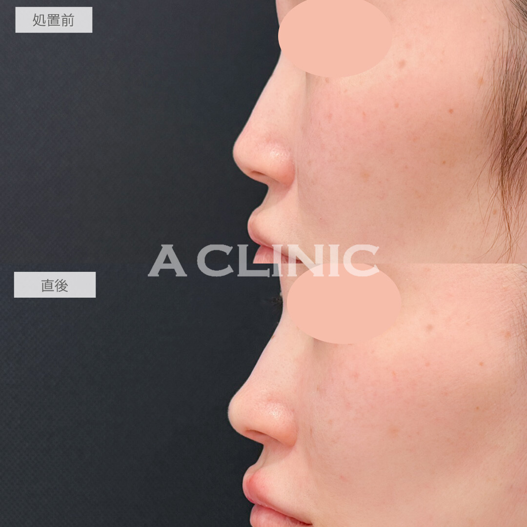 コリアンノーズでダウンタイムなしで鼻のアップデートができました！処置前と直後の症例です(30代女性)