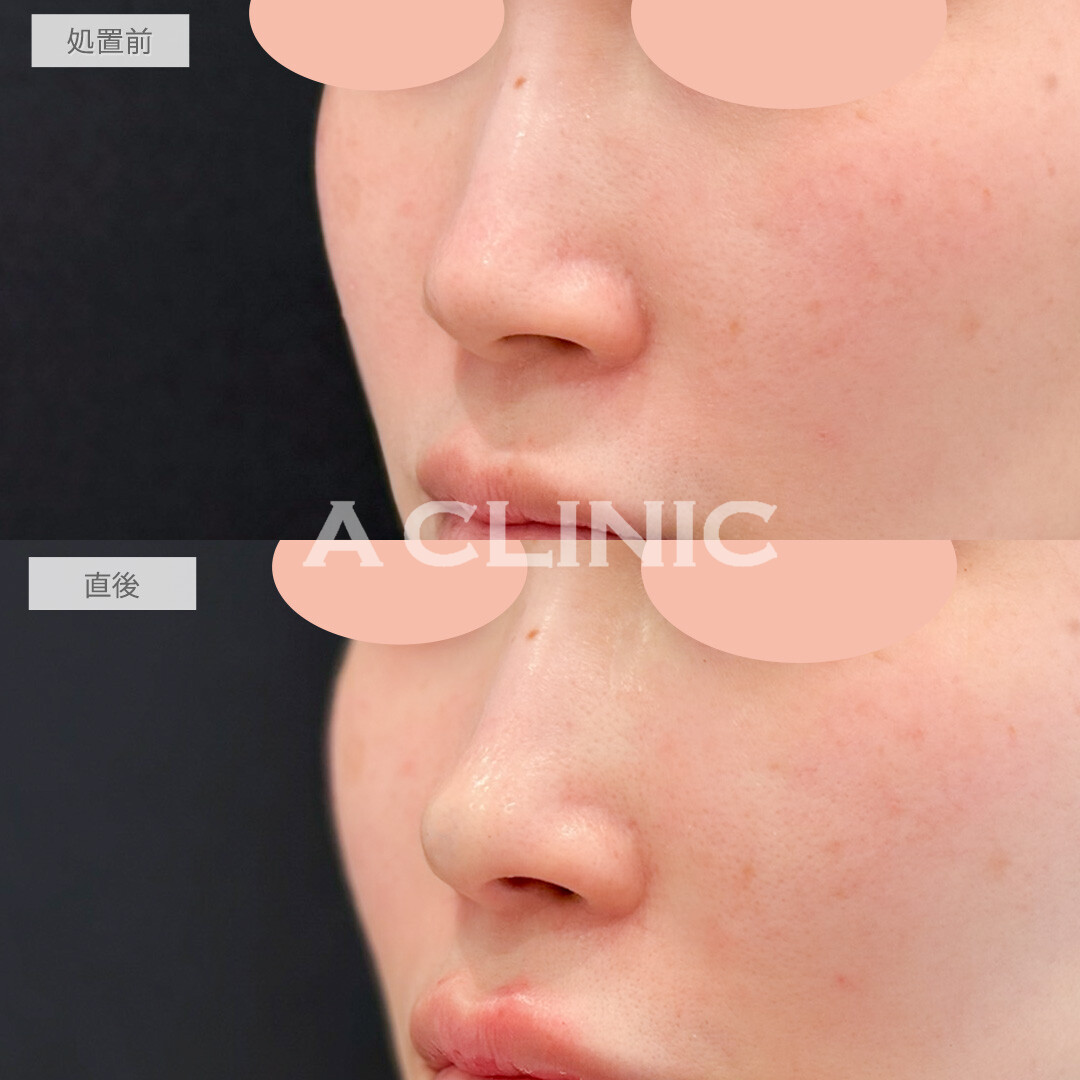 コリアンノーズでダウンタイムなしで鼻のアップデートができました！処置前と直後の症例です(30代女性)