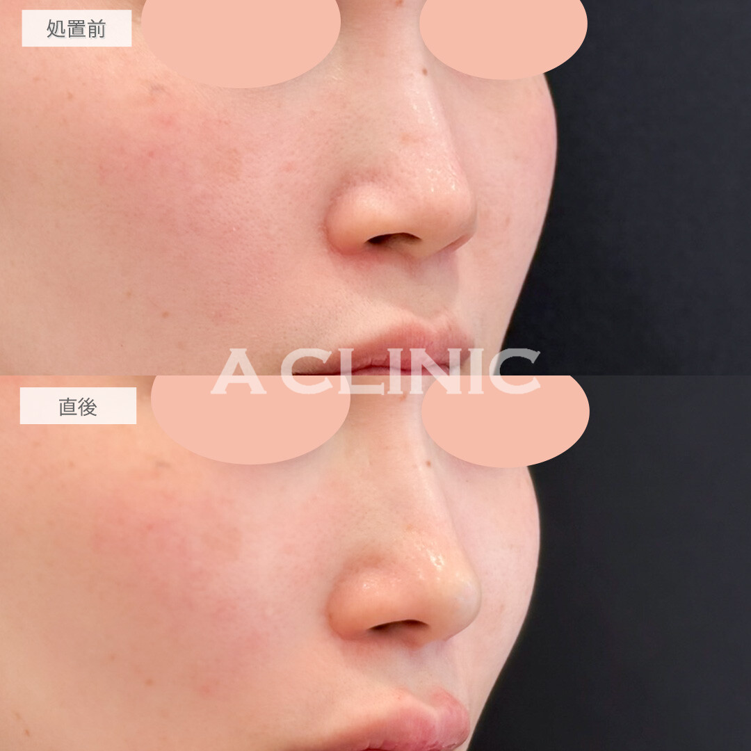 コリアンノーズでダウンタイムなしで鼻のアップデートができました！処置前と直後の症例です(30代女性)