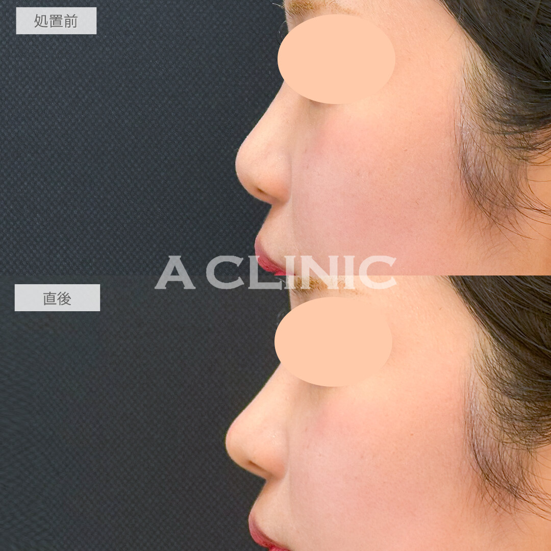 コリアンノーズで丸い鼻先をツンとさせることができました！処置前と直後の症例です(20代女性)