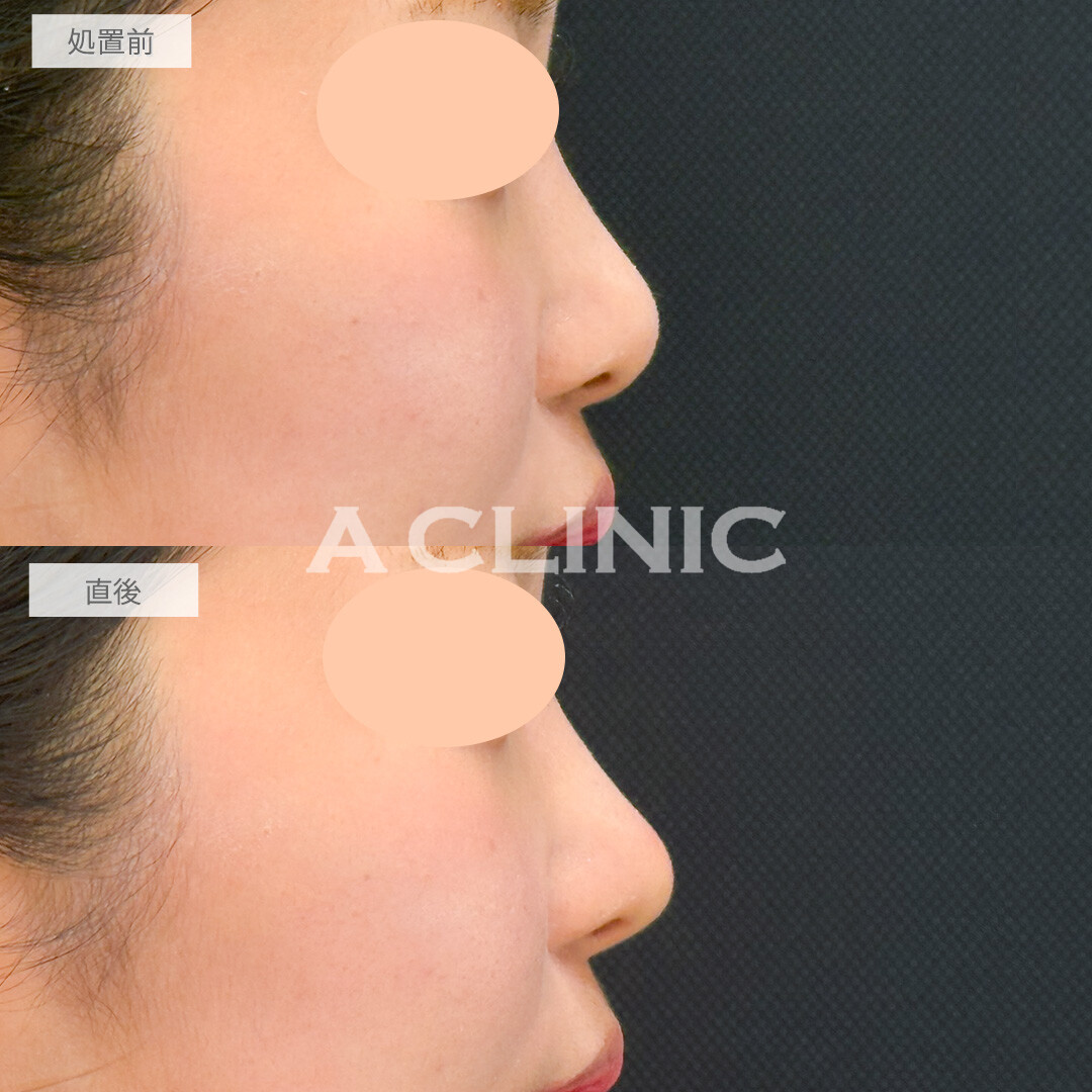 コリアンノーズで丸い鼻先をツンとさせることができました！処置前と直後の症例です(20代女性)