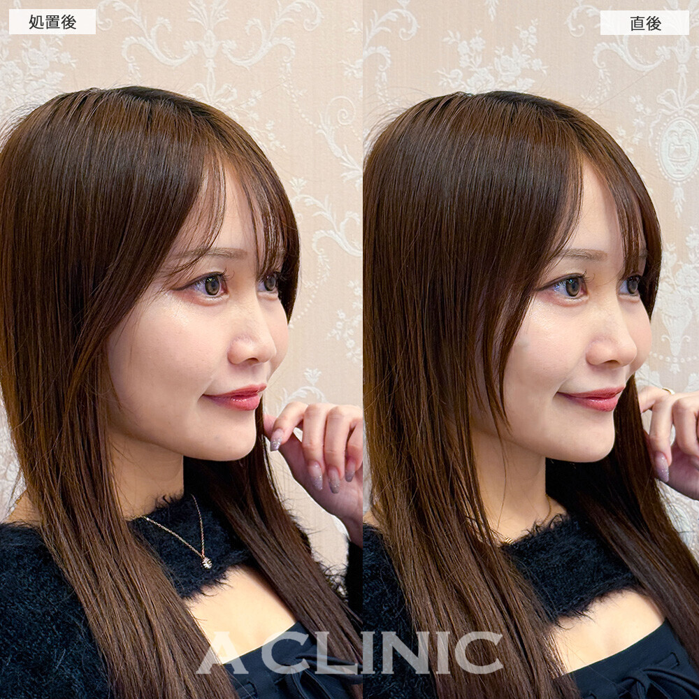 コリアンノーズで丸い鼻がツンとした鼻に！こちら処置前と直後の症例です(30代女性)