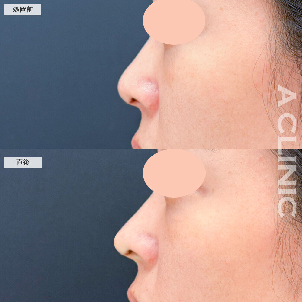 コリアンノーズならヒアルロン酸だけで鼻中隔を延長できます！こちら処置前と直後の症例です(30代女性)