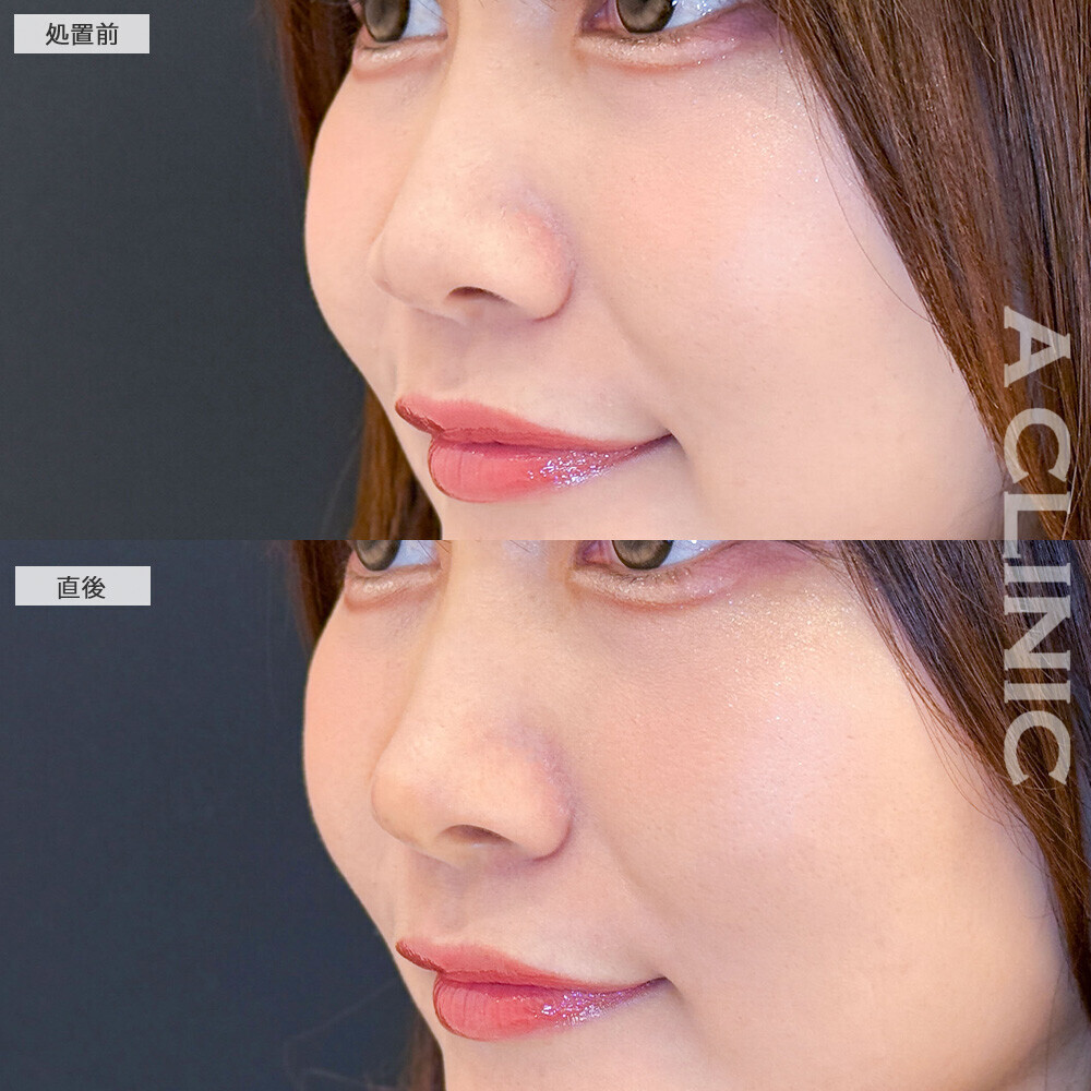 コリアンノーズで丸い鼻がツンとした鼻に！こちら処置前と直後の症例です(30代女性)