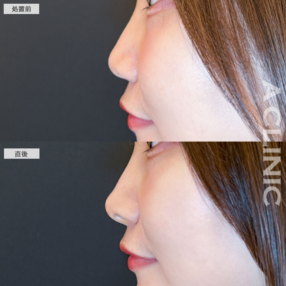 コリアンノーズで丸い鼻がツンとした鼻に！こちら処置前と直後の症例です(30代女性)