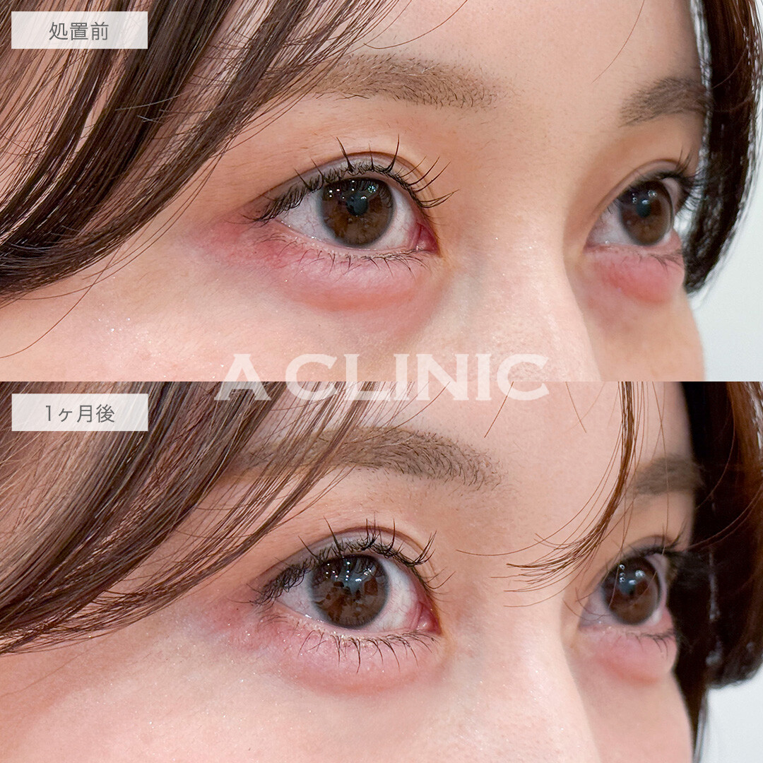 目の下のクマ取りで目元の印象が明るくなりました！処置前と1ヶ月後の症例です(20代女性)