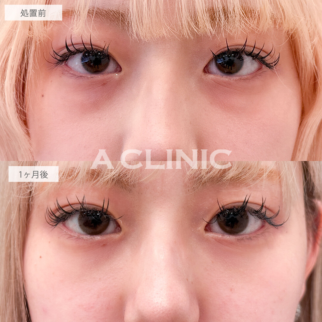 目の下のクマ取りで写真映えが劇的に良くなりました！こちら処置前と1か月後の症例です(20代女性)