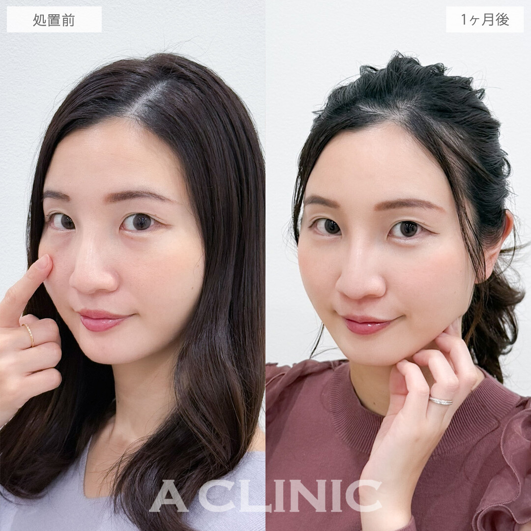 目の下のクマ取りで原因の脂肪をとって明るい印象になりました！こちら処置前と1か月後の症例です(20代女性)