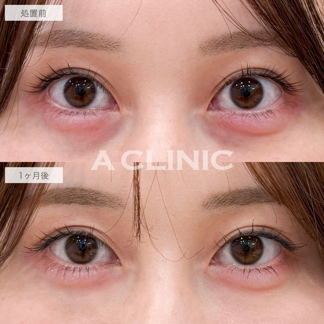 目の下のクマ取りで目元の印象が明るくなりました！処置前と1ヶ月後の症例です(20代女性)