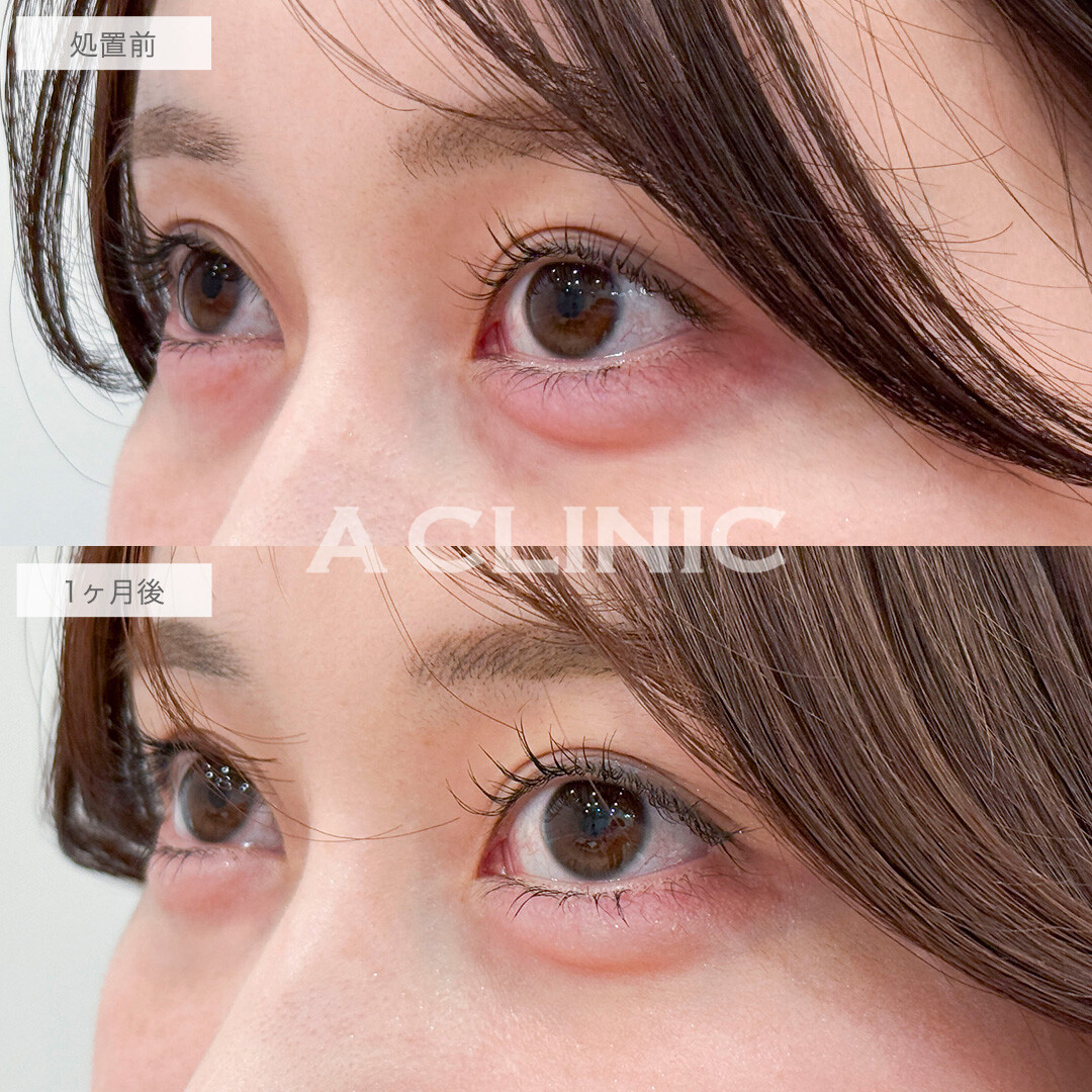 目の下のクマ取りで目元の印象が明るくなりました！処置前と1ヶ月後の症例です(20代女性)