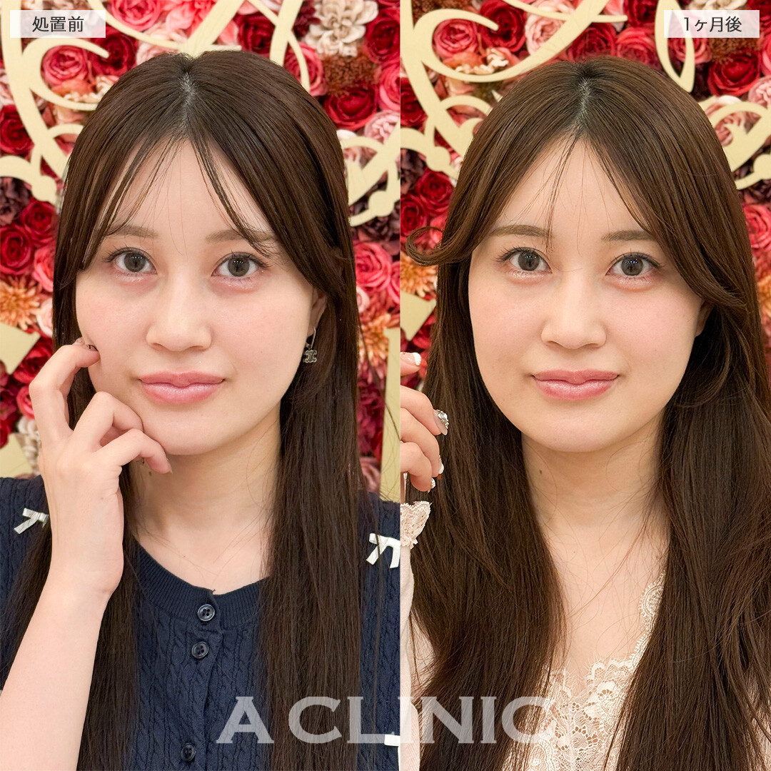 目の下のクマ取りで目元の印象が明るくなりました！処置前と1ヶ月後の症例です(20代女性)