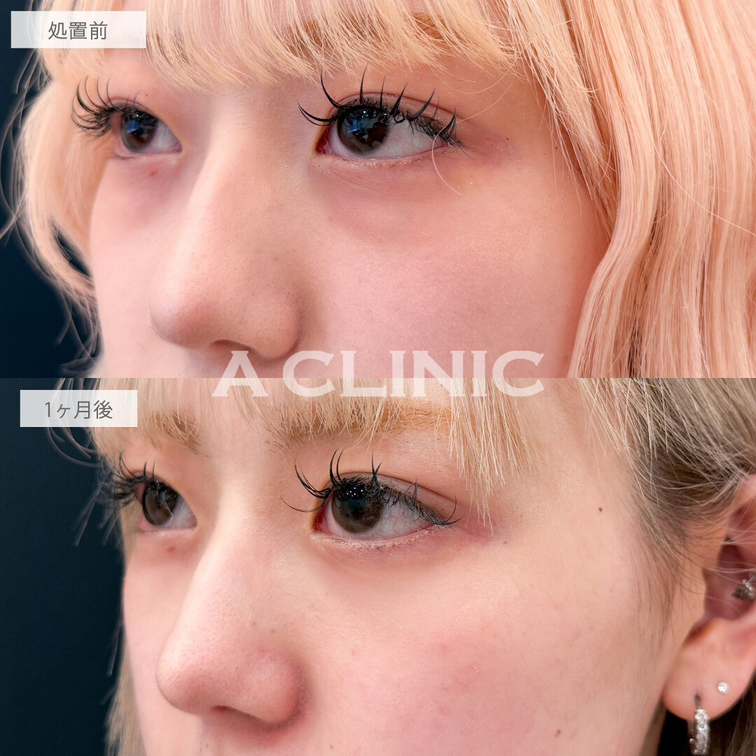 目の下のクマ取りで写真映えが劇的に良くなりました！こちら処置前と1か月後の症例です(20代女性)