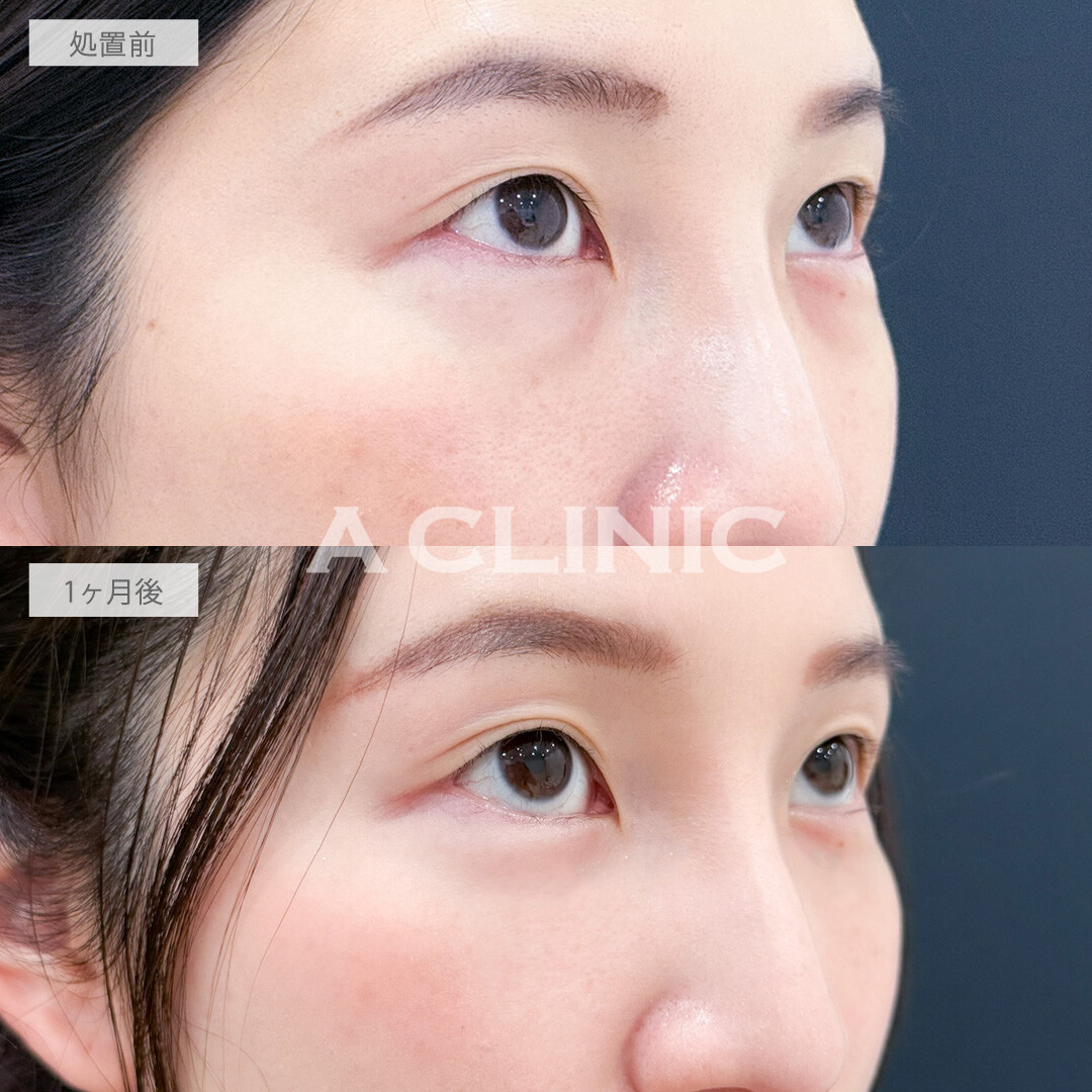 目の下のクマ取りで原因の脂肪をとって明るい印象になりました！こちら処置前と1か月後の症例です(20代女性)