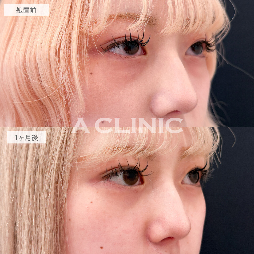 目の下のクマ取りで写真映えが劇的に良くなりました！こちら処置前と1か月後の症例です(20代女性)