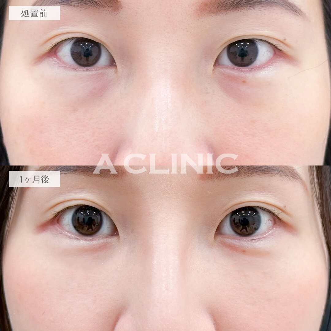目の下のクマ取りで原因の脂肪をとって明るい印象になりました！こちら処置前と1か月後の症例です(20代女性)