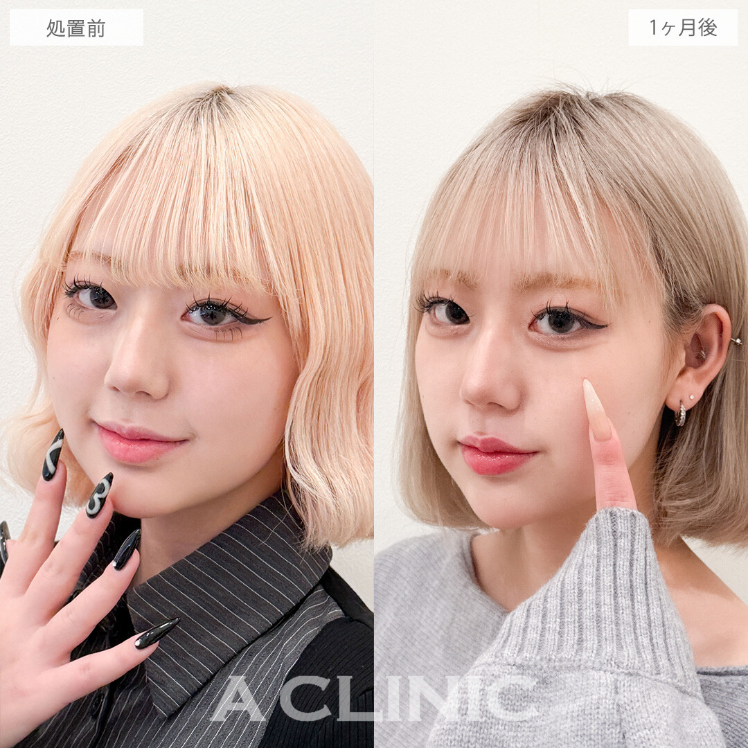 目の下のクマ取りで写真映えが劇的に良くなりました！こちら処置前と1か月後の症例です(20代女性)