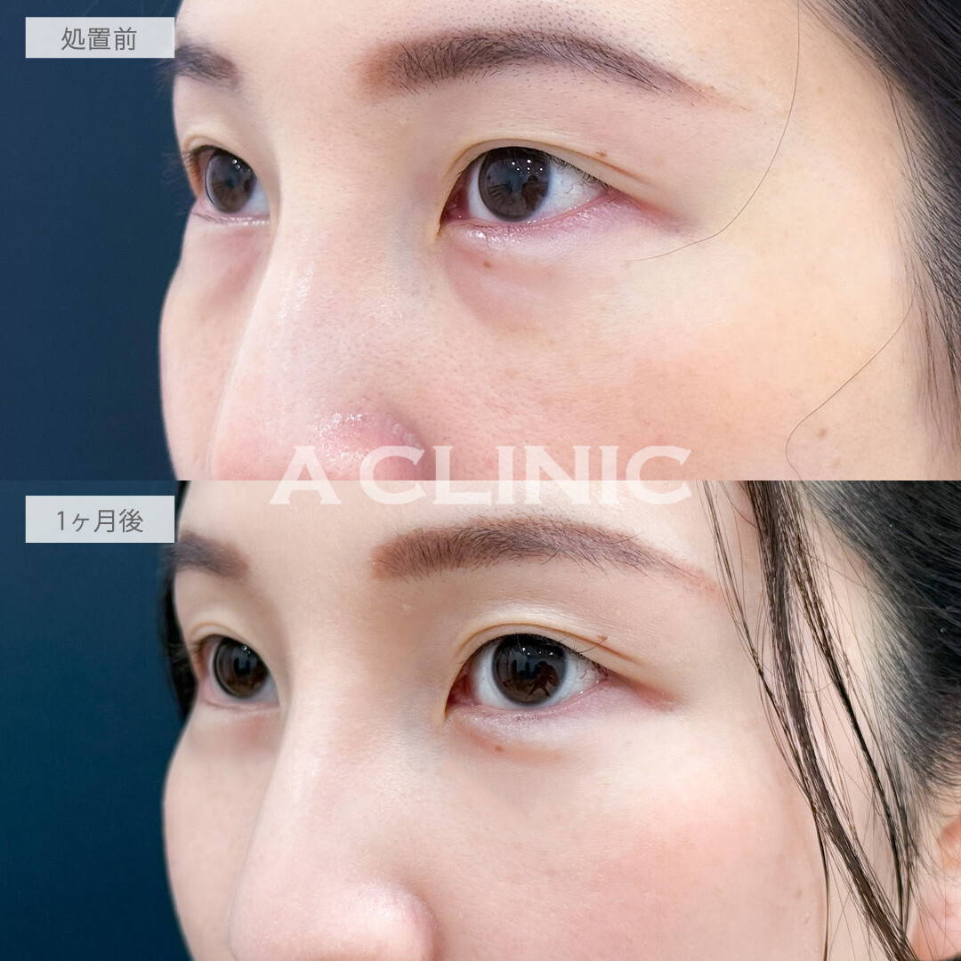 目の下のクマ取りで原因の脂肪をとって明るい印象になりました！こちら処置前と1か月後の症例です(20代女性)