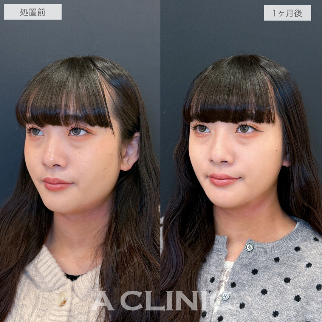 1day小顔脂肪吸引と小顔エラボトックスで周りから褒められる究極の小顔が手に入りました！処置前と1ヶ月後の症例です(20代女性)