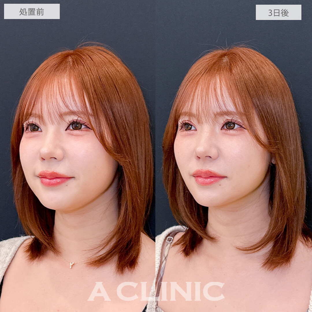 1day小顔脂肪吸引でナチュラルに顔面アプデが叶う！処置前と3日後の症例です(30代女性)