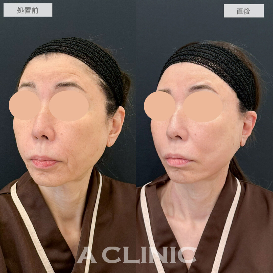 1day小顔脂肪吸引で直後から若返りが可能に！処置前と直後の症例です(60代女性)