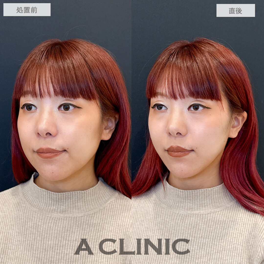 Aスレッドで左右差が改善され即日理想の輪郭に！処置前と直後の症例です(30代女性)