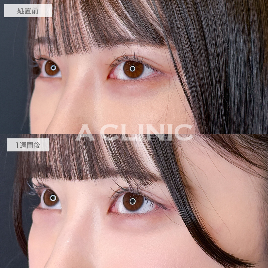 パーフェクトアイズで左右差と面長な印象が改善されました！処置前と1週間後の症例です(20代女性)