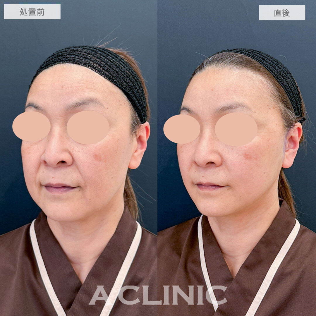 A式美肌たるみ切開で直後からほうれい線がなくなりたるみのない若々しいお顔に！処置前と直後の症例です(50代女性)