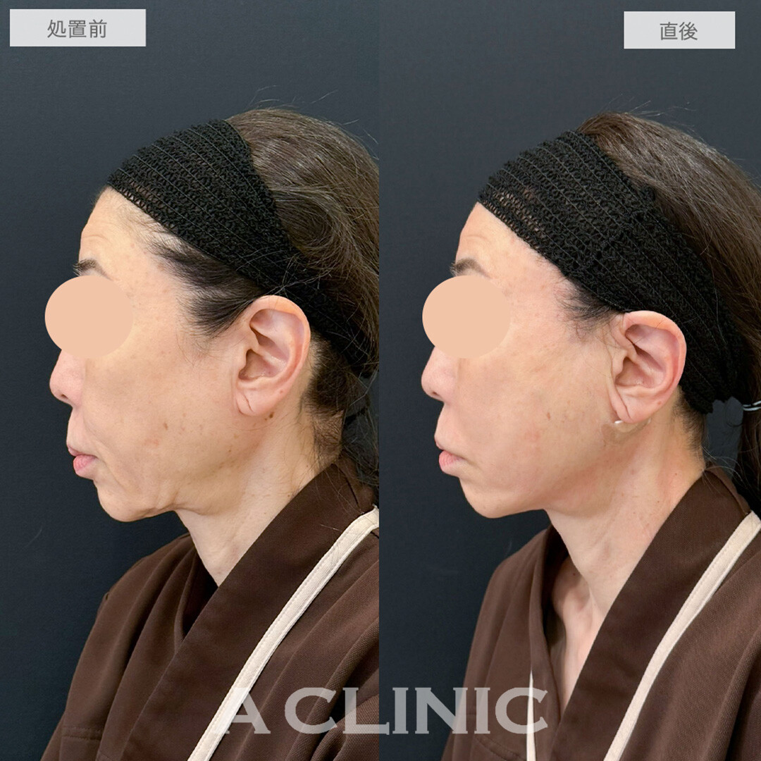1day小顔脂肪吸引で直後から若返りが可能に！処置前と直後の症例です(60代女性)