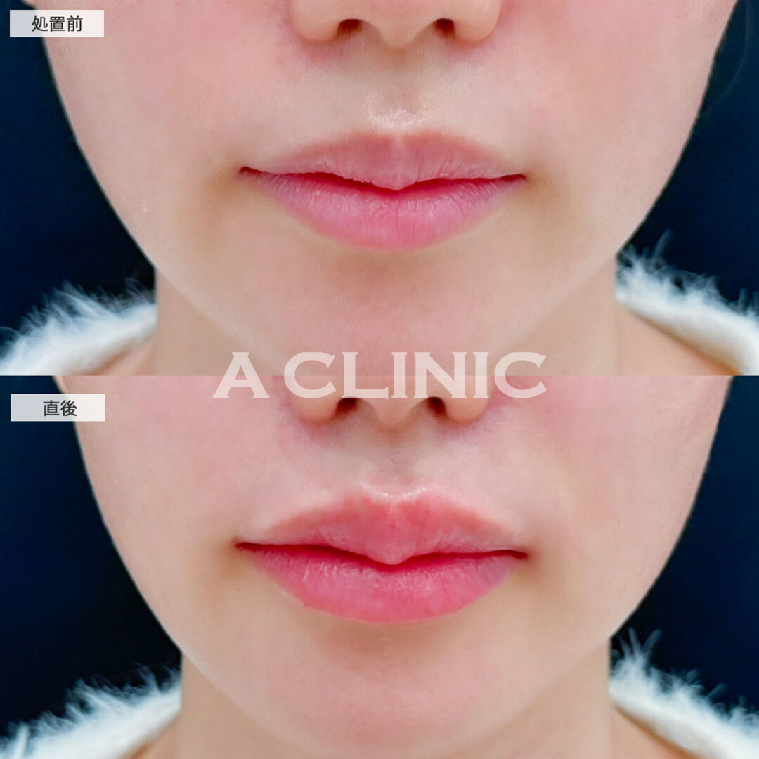 リップヒアルロン酸注入で唇に厚みが出て可愛く存在感のある口元に！こちら処置前と直後の症例です(20代女性)
