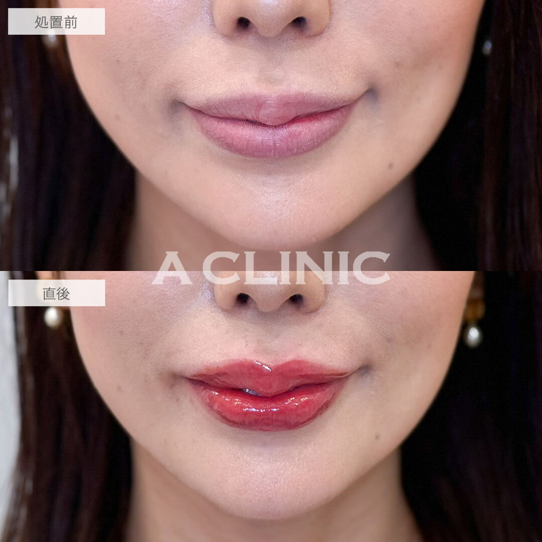 スマイルリップで唇のボリュームアップし華やかな口元へ！こちら処置前と直後の症例です(30代女性)