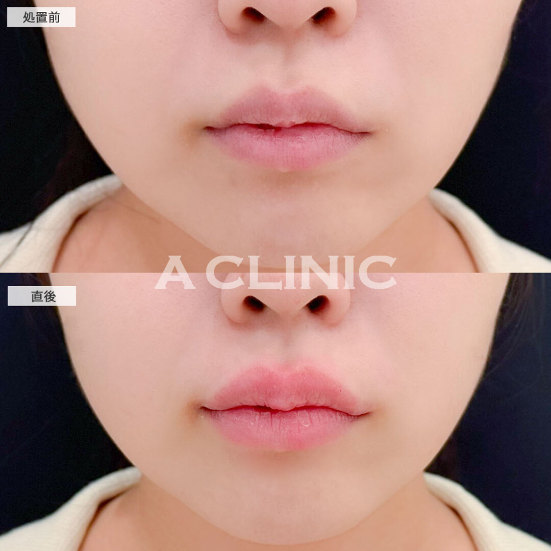 リップヒアルロン酸注入で直後からボリュームが出てより可愛い口元になりました！こちら処置前と直後の症例です(20代女性)