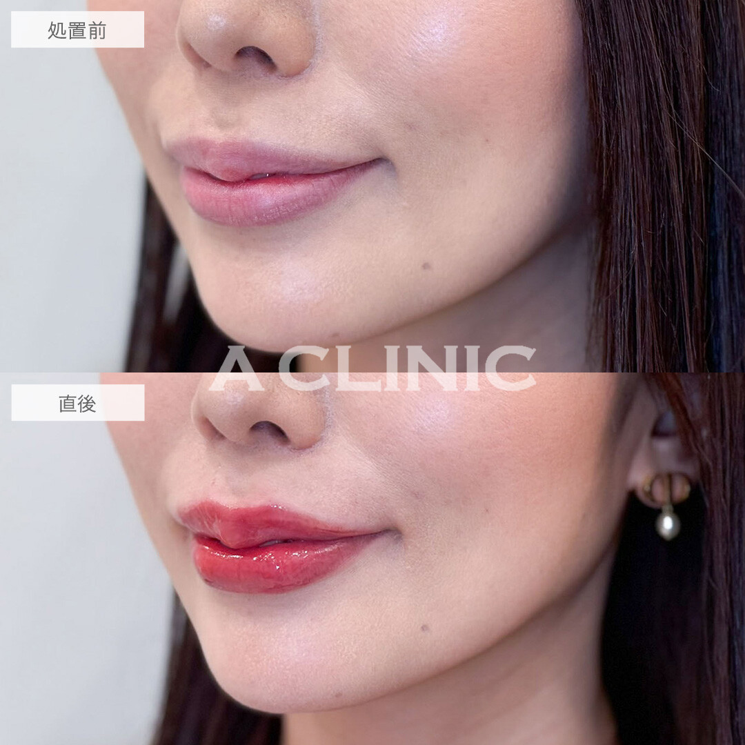 スマイルリップで唇のボリュームアップし華やかな口元へ！こちら処置前と直後の症例です(30代女性)
