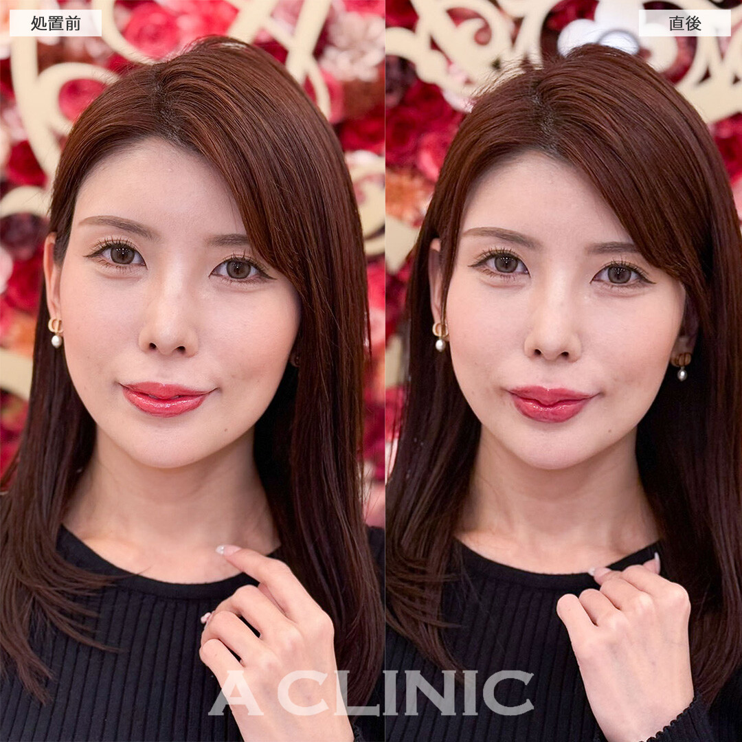 スマイルリップで唇のボリュームアップし華やかな口元へ！こちら処置前と直後の症例です(30代女性)