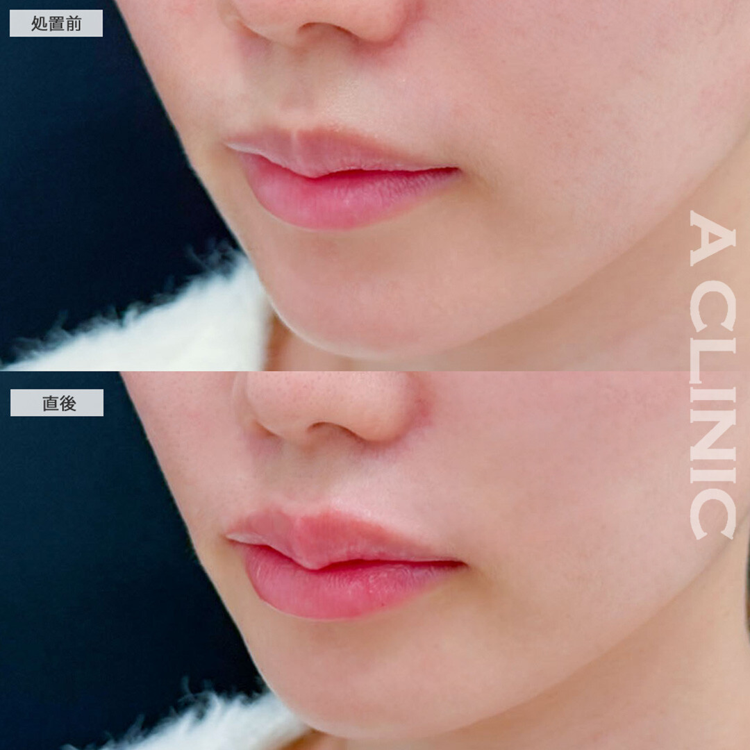 リップヒアルロン酸注入で唇に厚みが出て可愛く存在感のある口元に！こちら処置前と直後の症例です(20代女性)