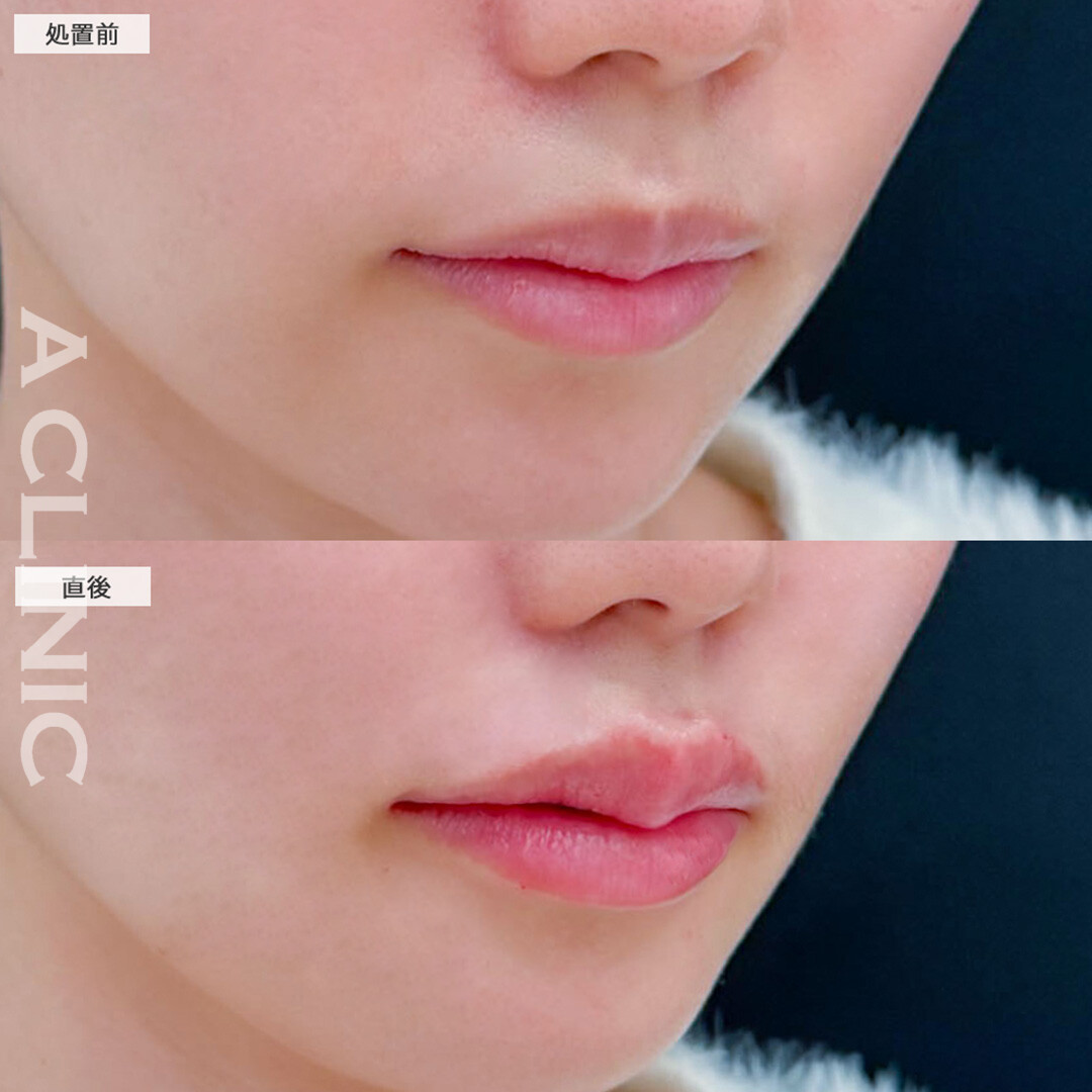 リップヒアルロン酸注入で唇に厚みが出て可愛く存在感のある口元に！こちら処置前と直後の症例です(20代女性)