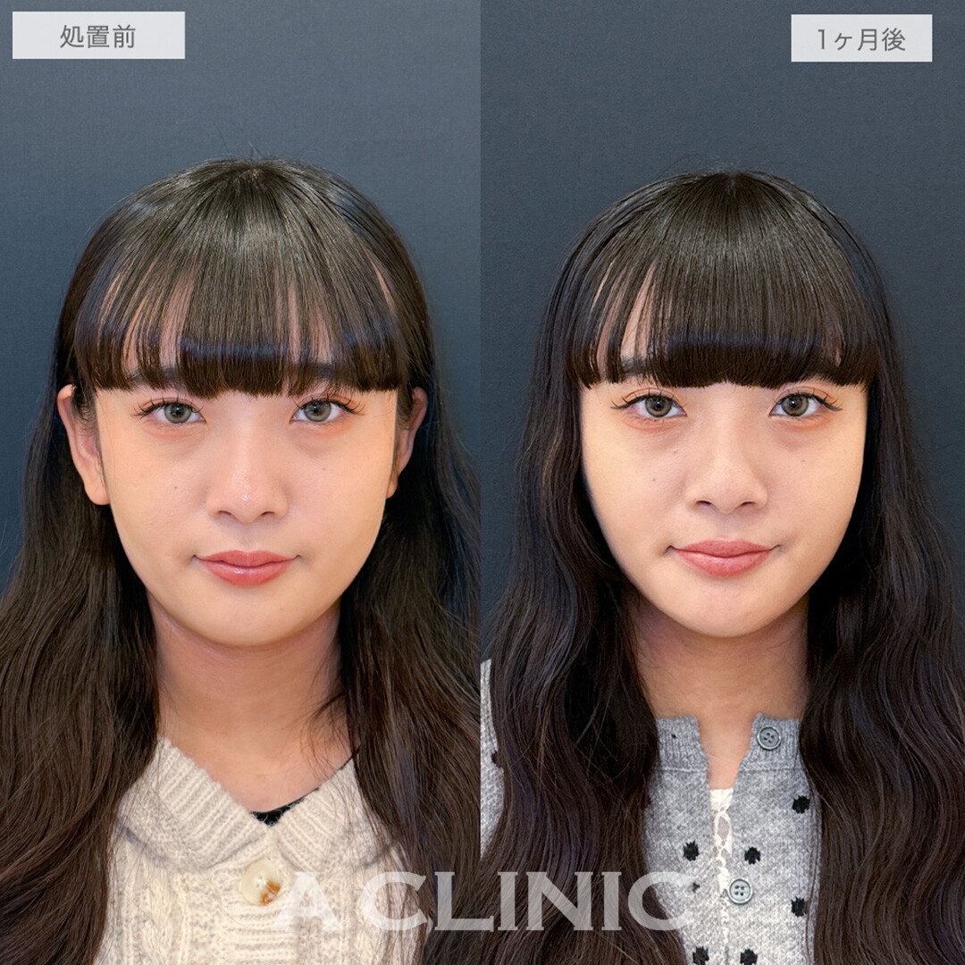 1day小顔脂肪吸引と小顔エラボトックスで周りから褒められる究極の小顔が手に入りました！処置前と1ヶ月後の症例です(20代女性)