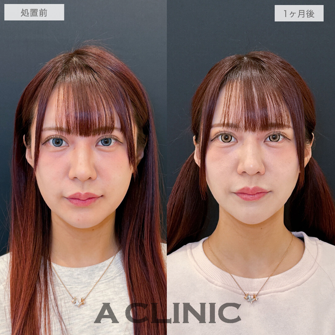 1day小顔脂肪吸引でフェイスラインがくっきりし、口横のもたつきもなくなりました！処置前と1ヶ月後の症例です(30代女性)