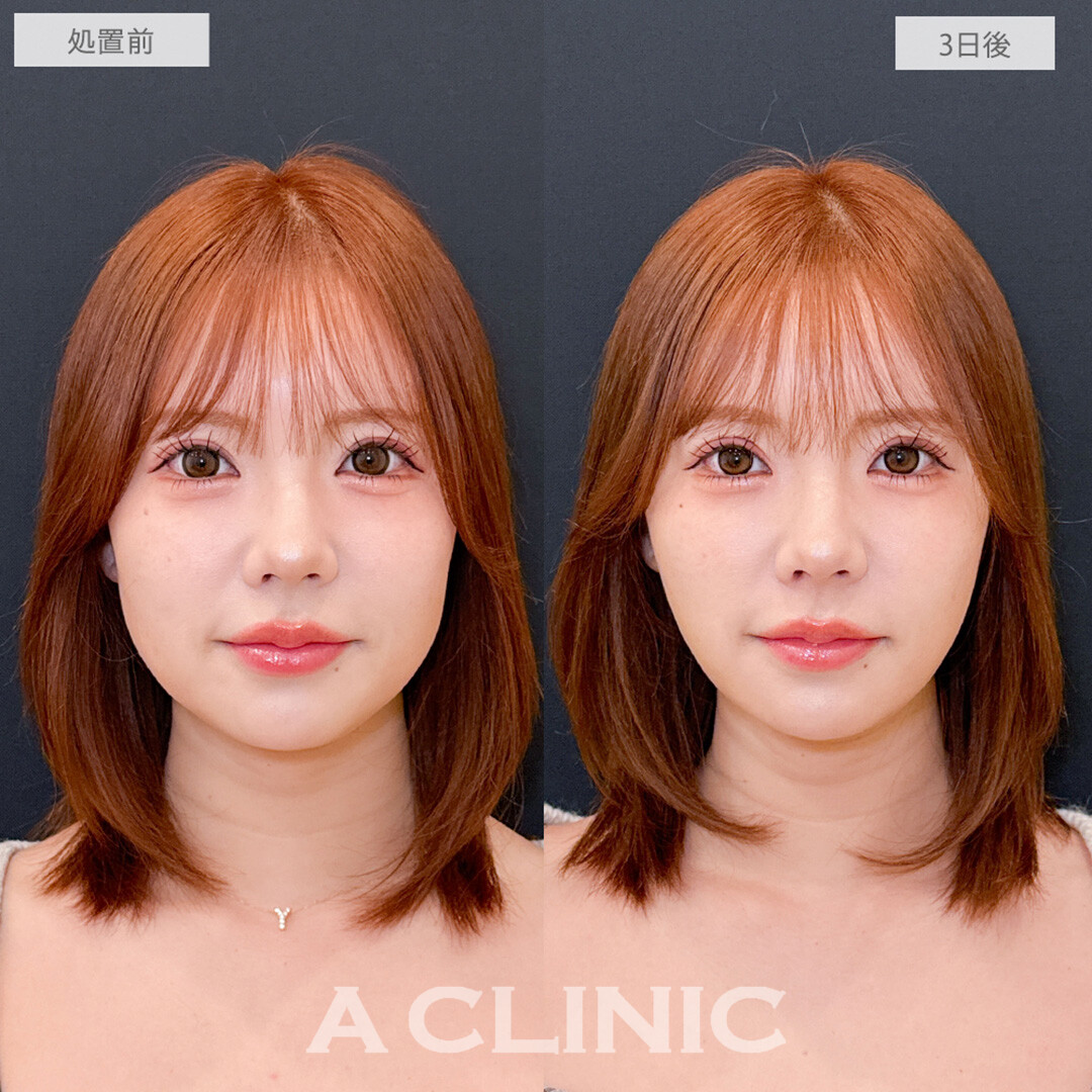 1day小顔脂肪吸引でナチュラルに顔面アプデが叶う！処置前と3日後の症例です(30代女性)