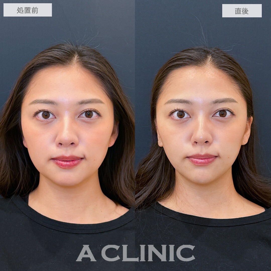 1day小顔脂肪吸引とあごへのヒアルロン酸注入でフェイスラインのもたつきが一気に引き上がる！処置前と直後の症例です(20代女性)