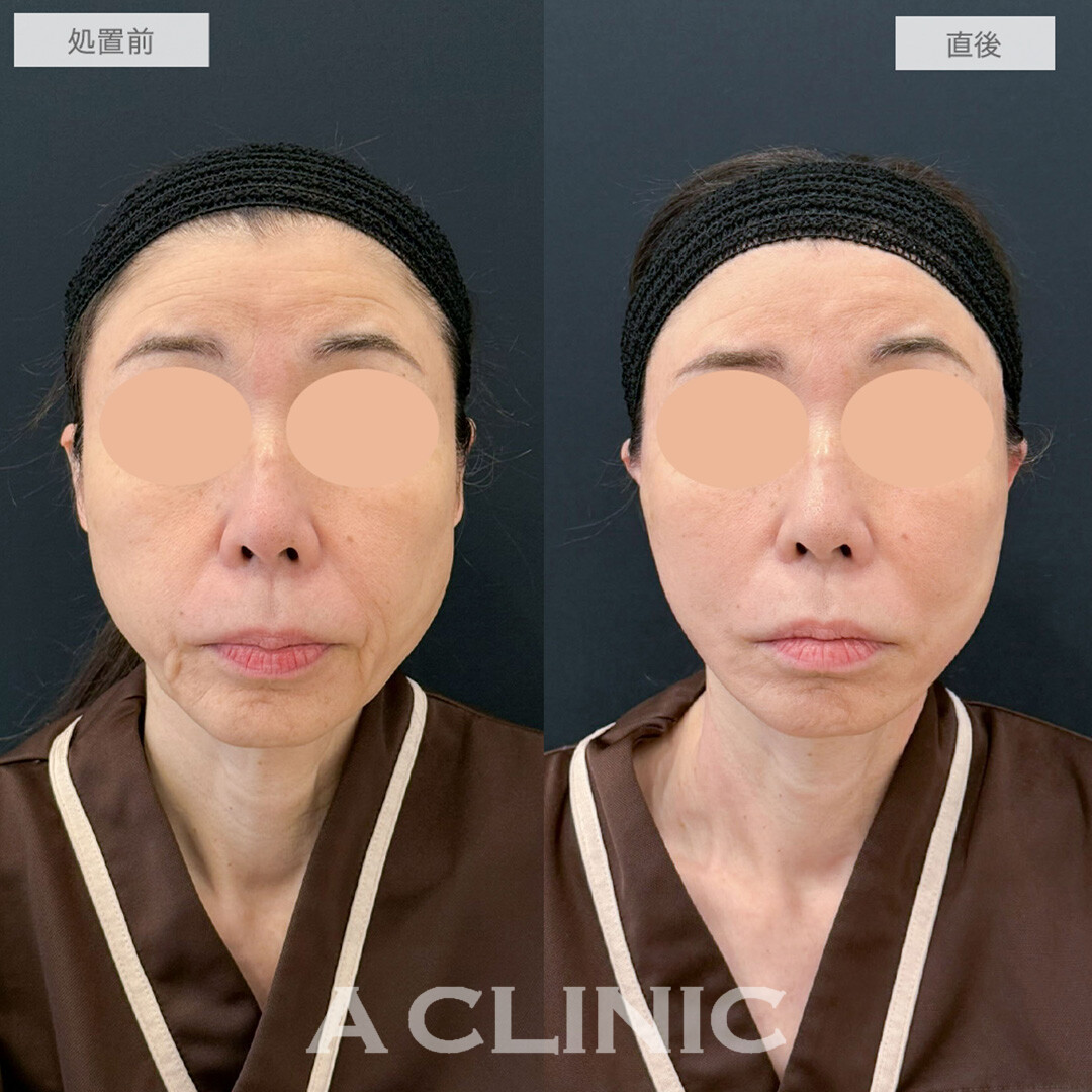 1day小顔脂肪吸引で直後から若返りが可能に！処置前と直後の症例です(60代女性)